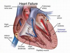 congestive-failure-heart