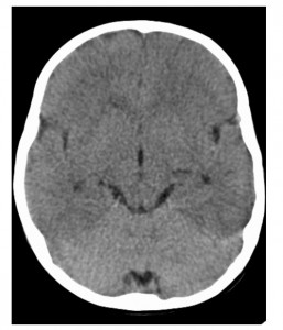 Cerebral Edema