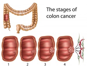 Colon_cancer stages (courtesy Wiki Commons)