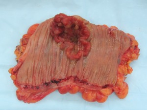 Colon Cancer (wiki)