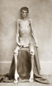 Starving Civil War Prisoner